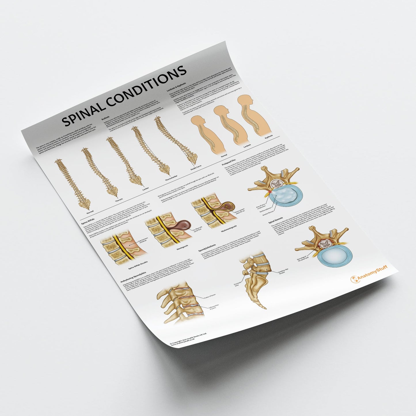 Spinal Conditions Chart / Poster - Part of Collection