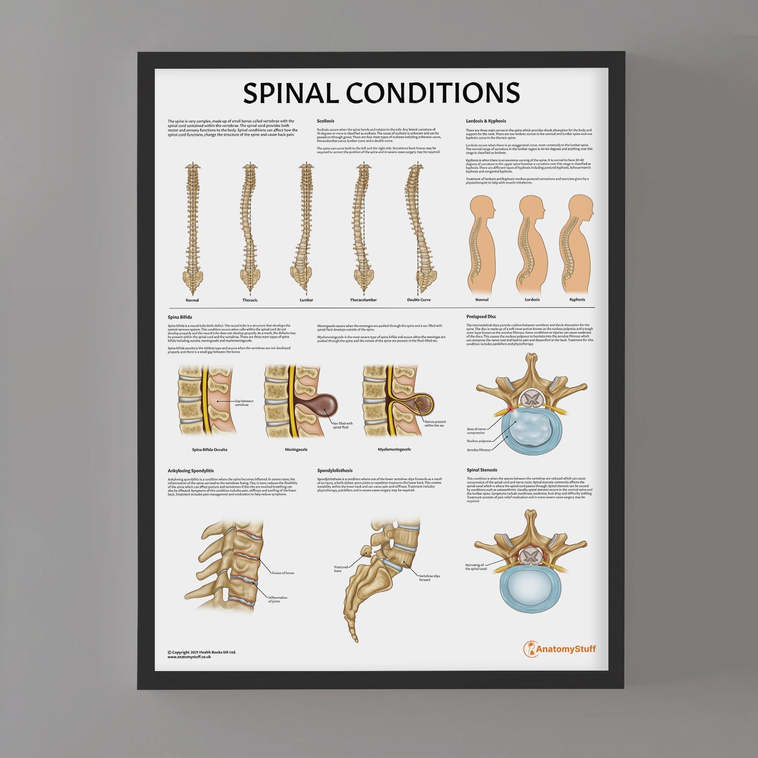 Spinal Conditions Chart / Poster - Part of Collection