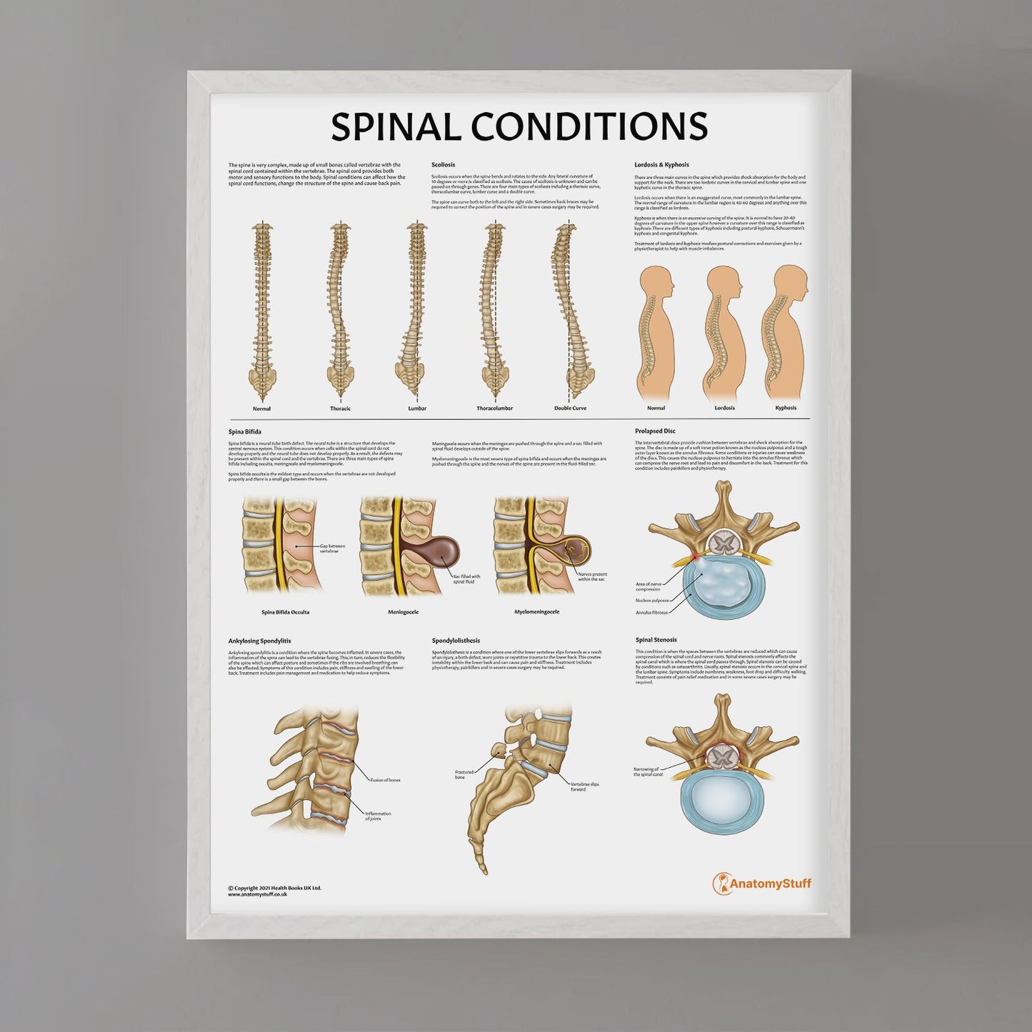 Spinal Conditions Chart / Poster - Part of Collection