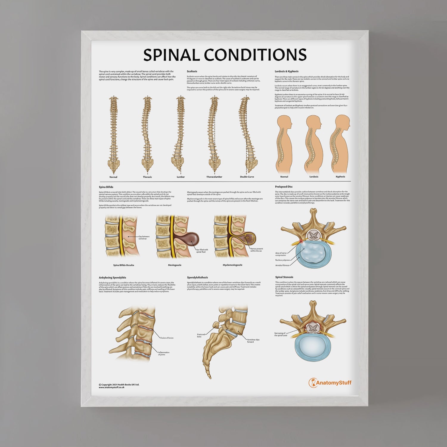 Spinal Conditions Chart / Poster - Part of Collection