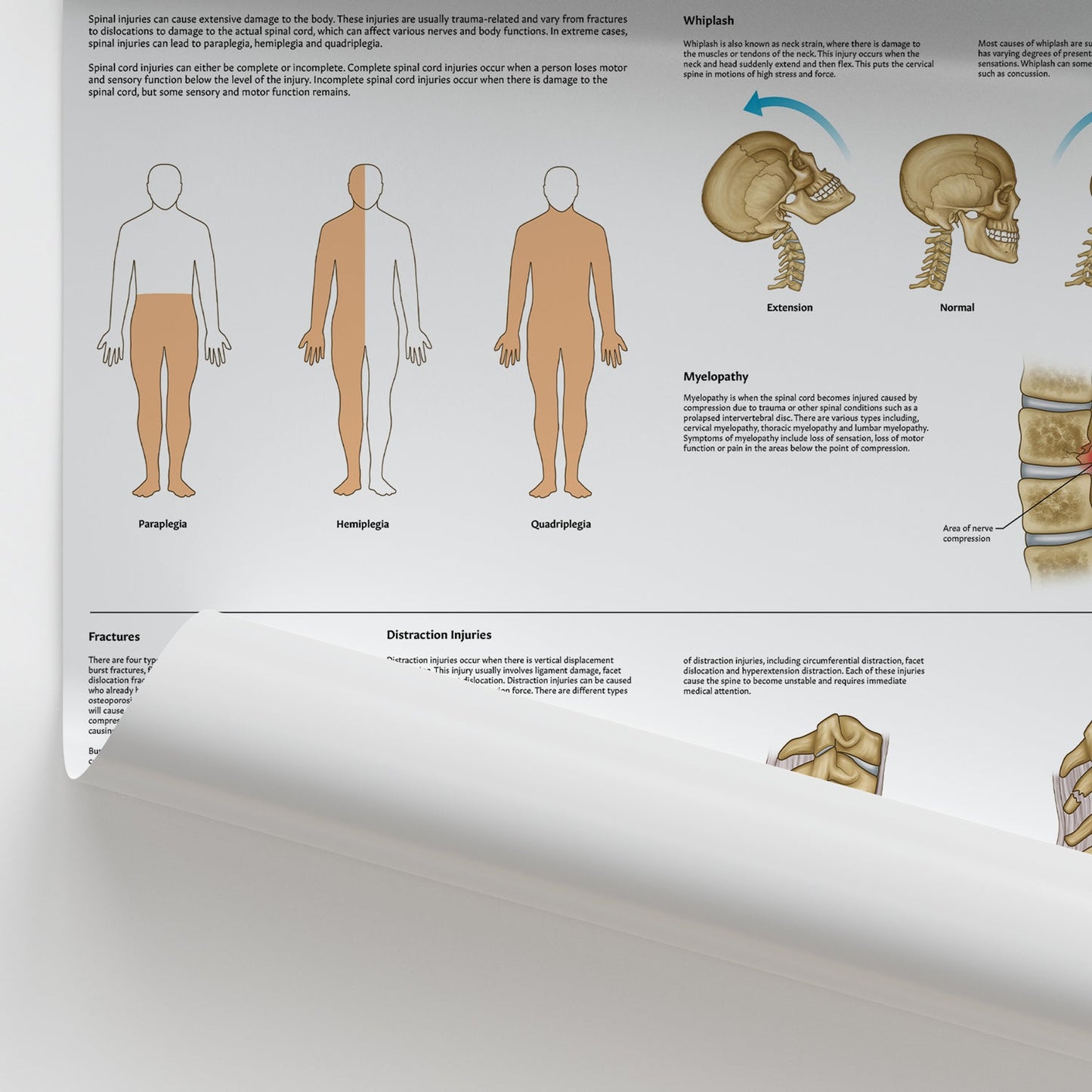 Spinal Injuries Chart / Poster - Part of Collection