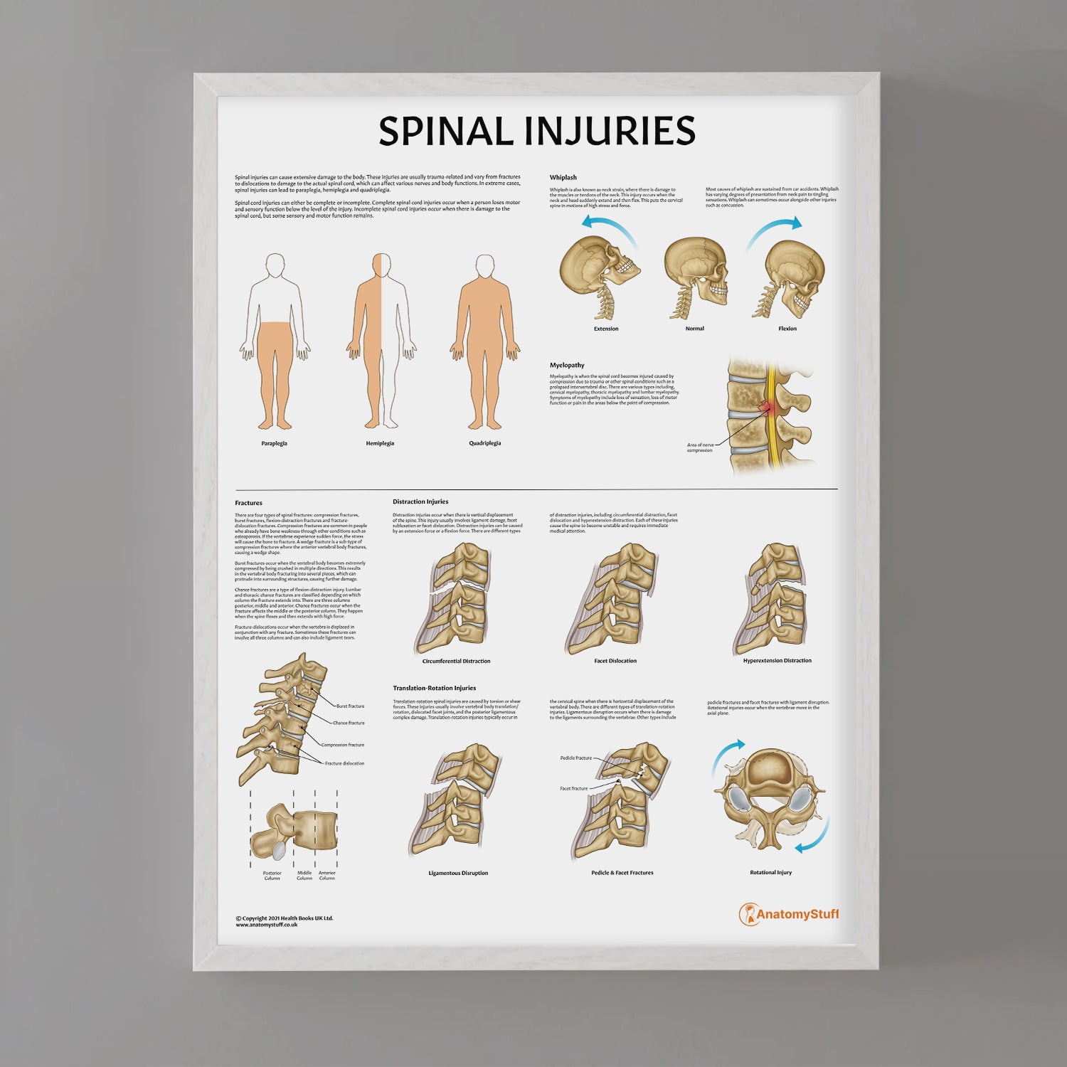 Laminated Spinal Injuries Chart | Spine Injuries Poster – AnatomyStuff