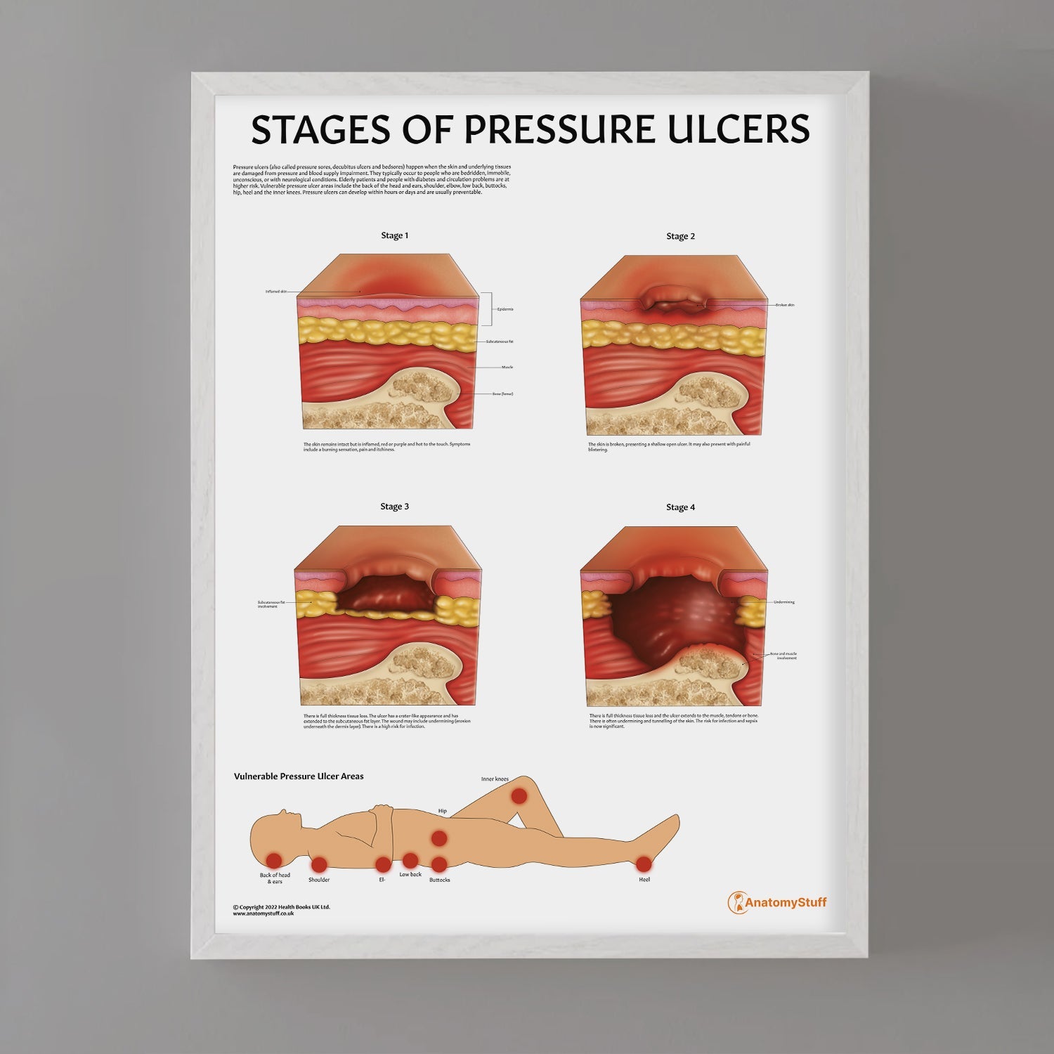 Stages of Pressure Ulcers Chart / Poster - Part of Collection