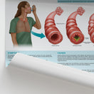 Switch The Anatomy of Asthma Chart / Poster 2 image