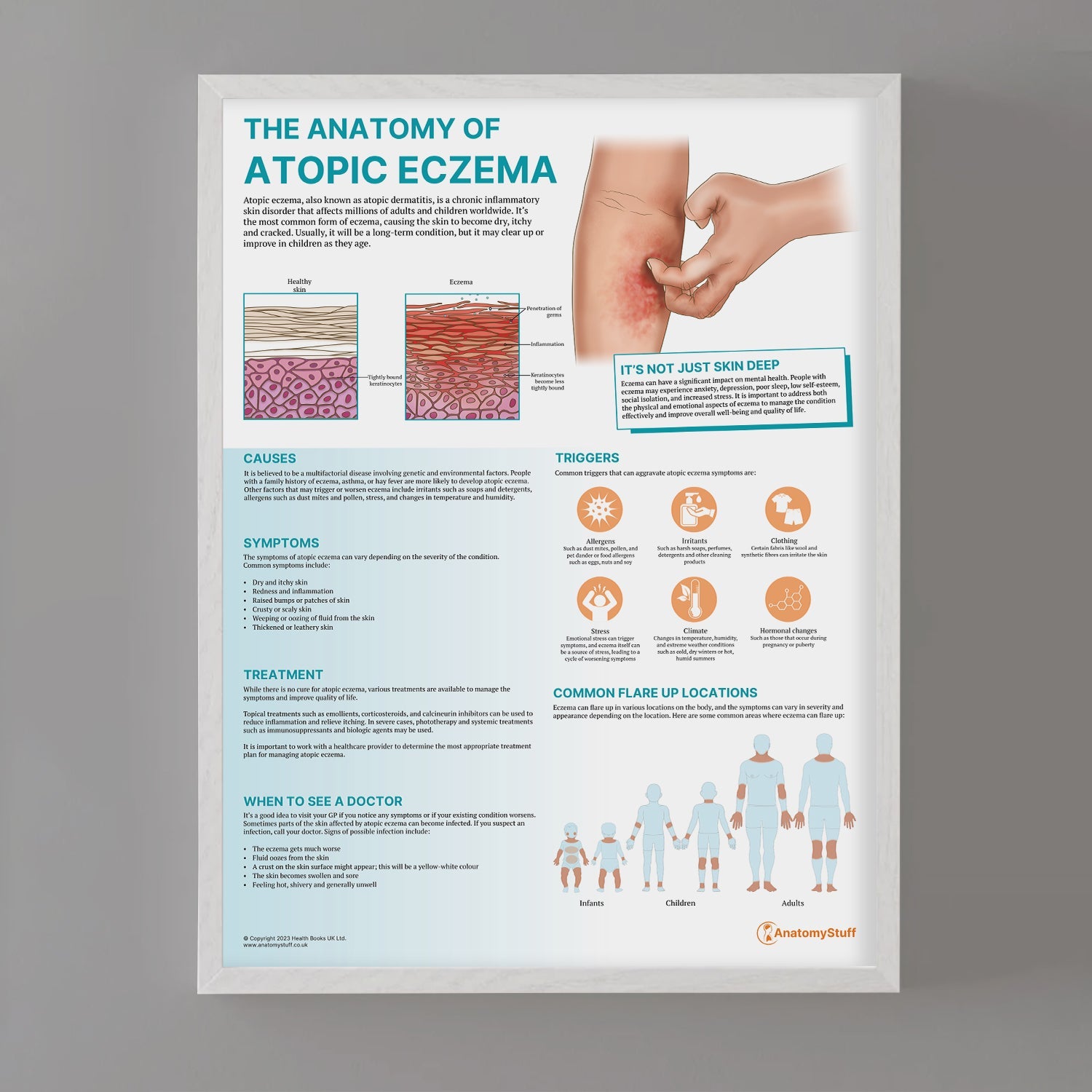The Anatomy of Atopic Eczema Chart / Poster - Part of Collection