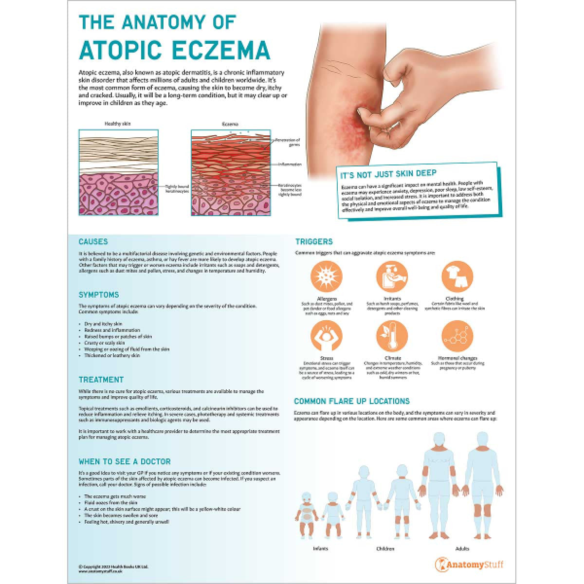 The Anatomy of Atopic Eczema Chart