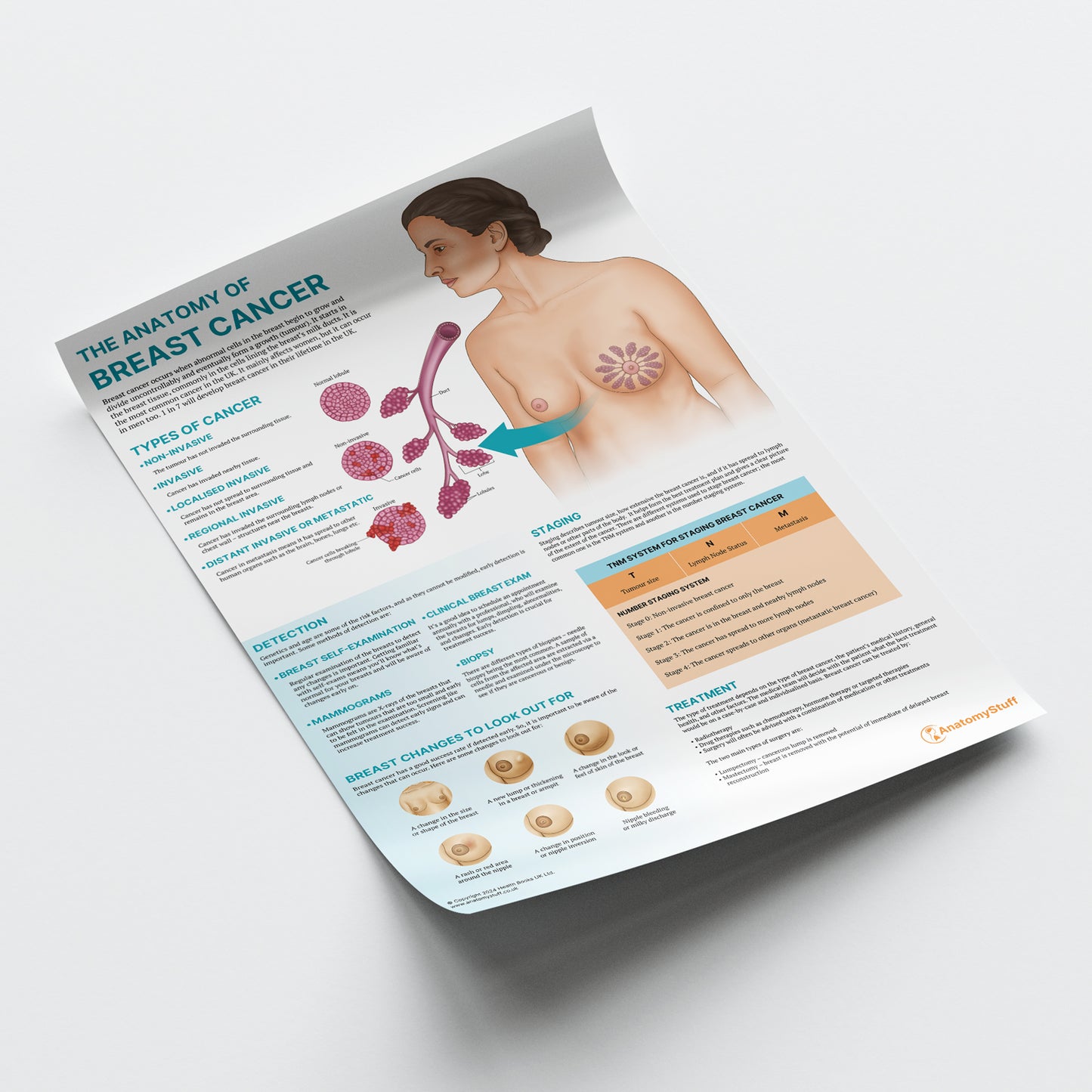 The Anatomy of Breast Cancer Chart / Poster
