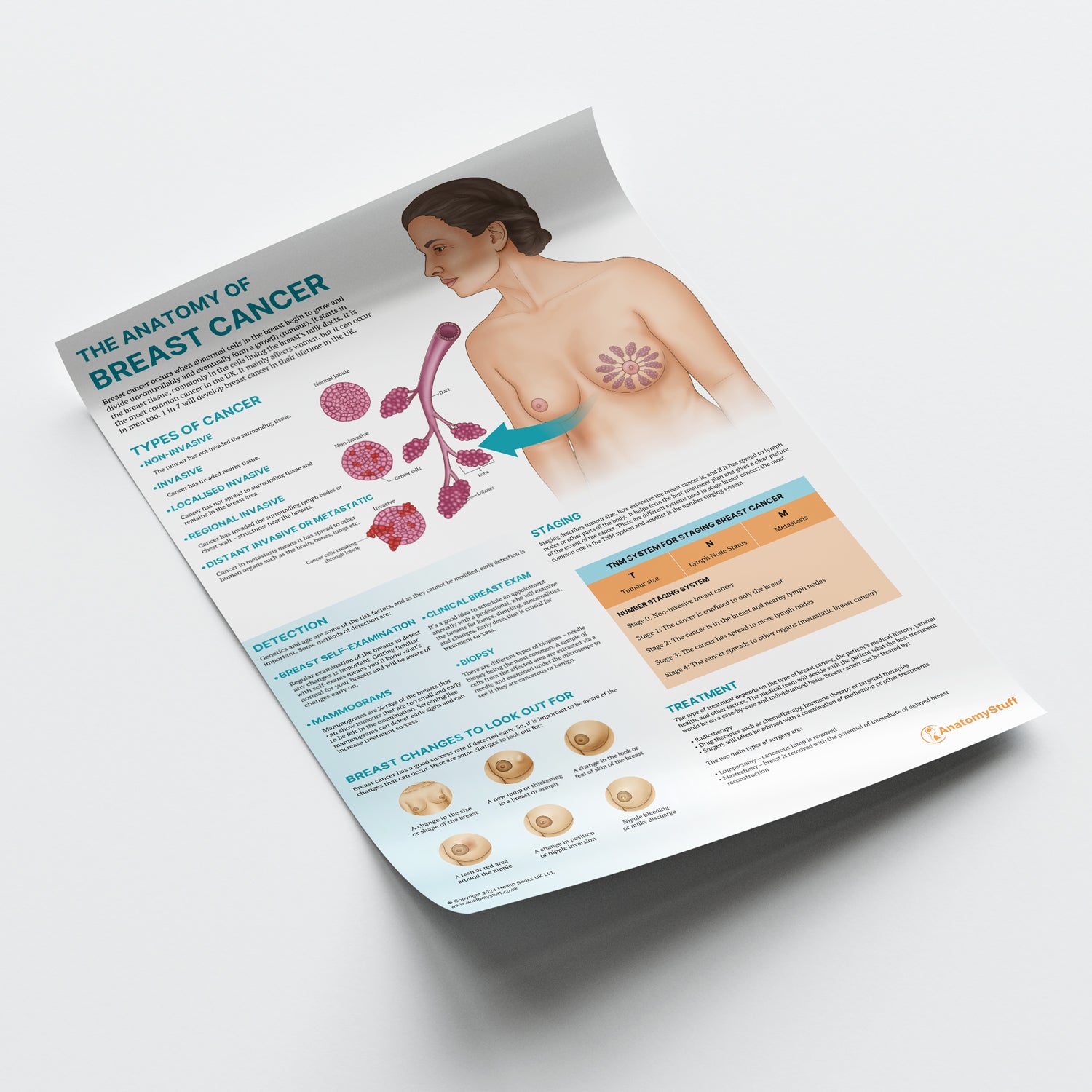 The Anatomy of Breast Cancer Chart / Poster