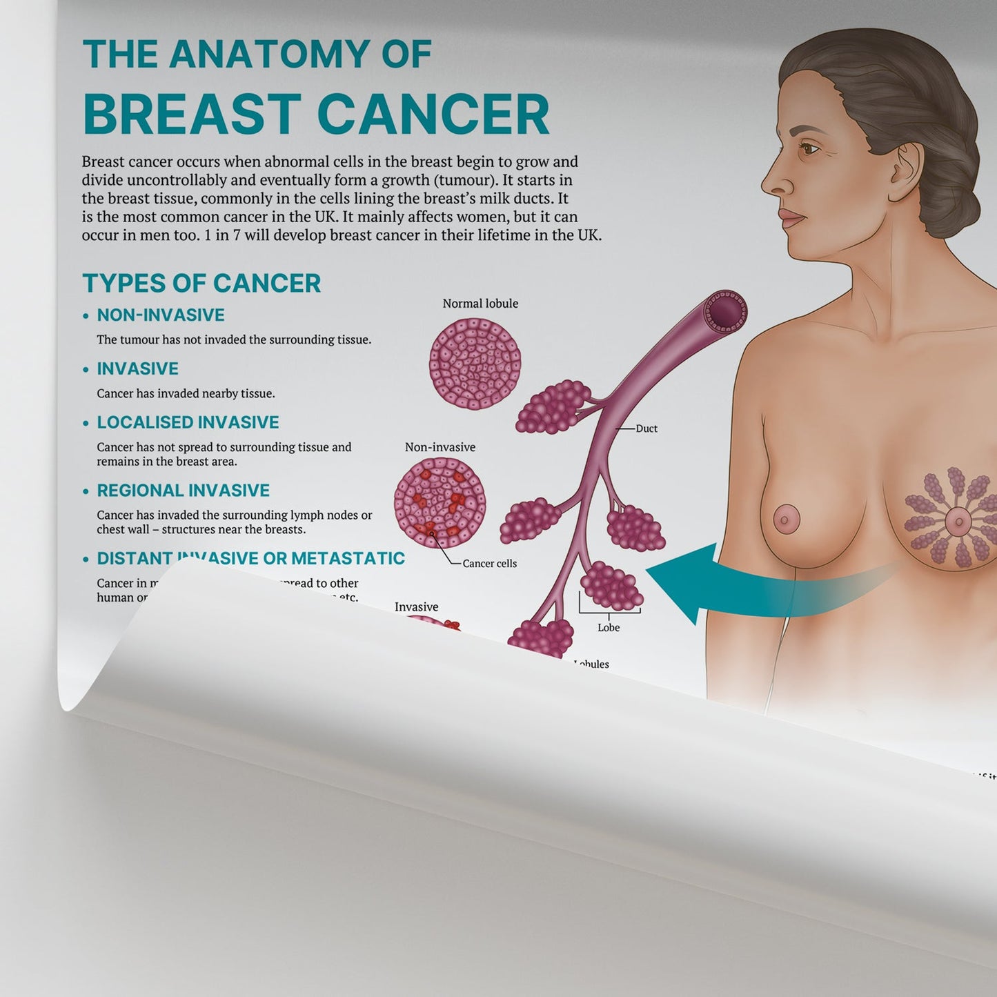 The Anatomy of Breast Cancer Chart / Poster - Part of Collection
