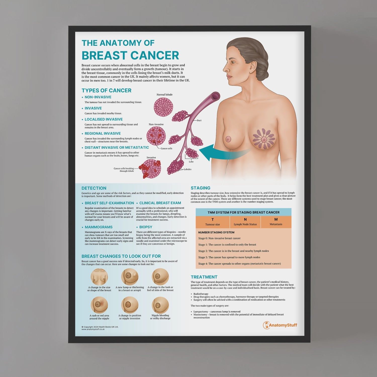 The Anatomy of Breast Cancer Chart / Poster - Part of Collection