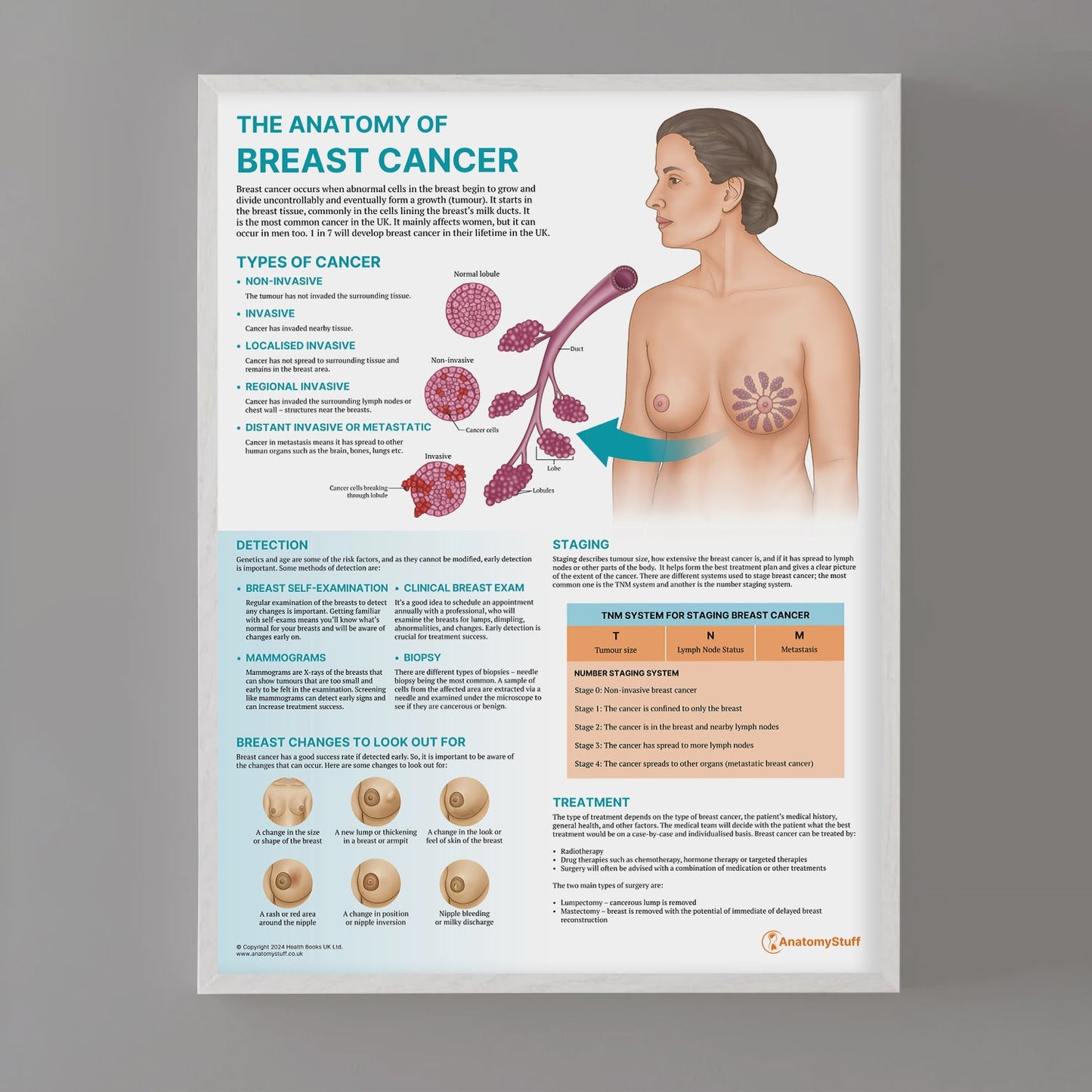 The Anatomy of Breast Cancer Chart / Poster - Part of Collection