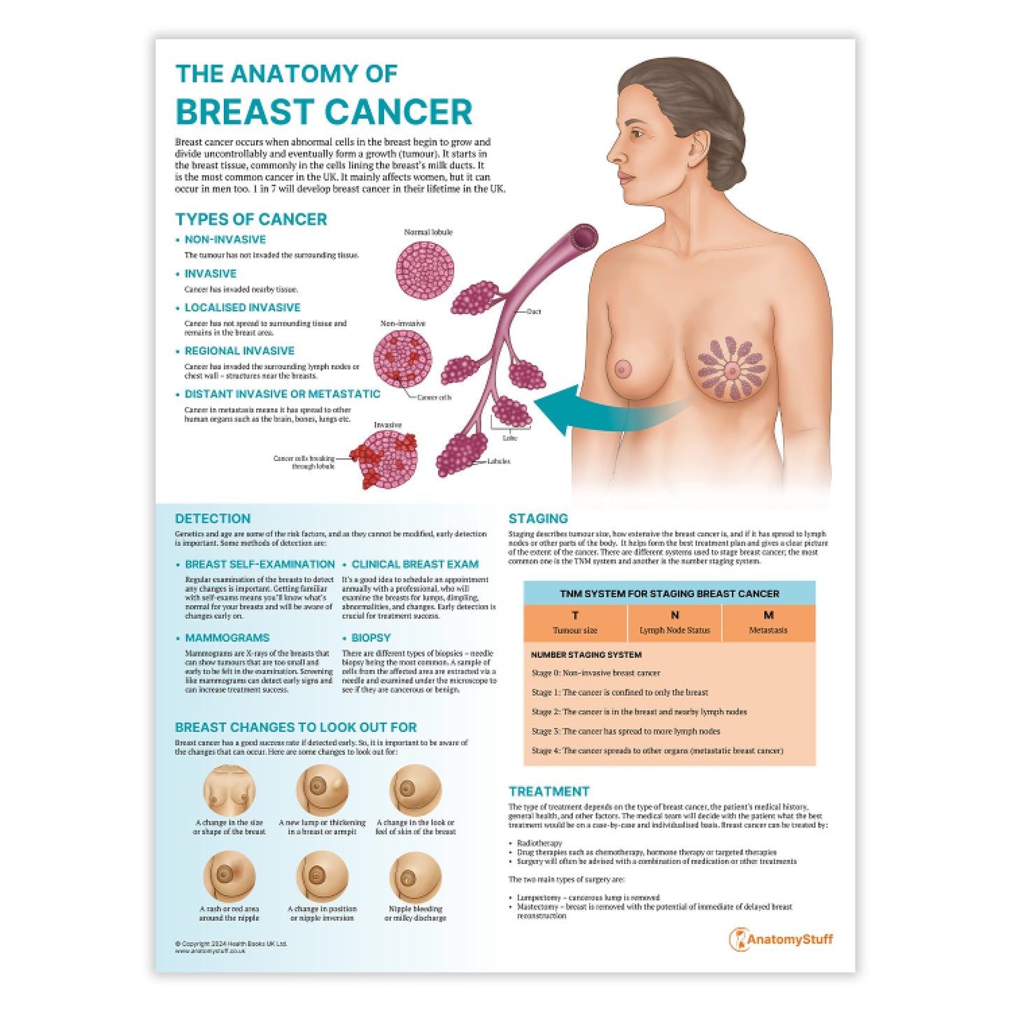The Anatomy of Breast Cancer Chart / Poster - Part of Collection