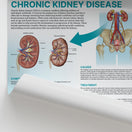 Switch The Anatomy of Chronic Kidney Disease Chart / Poster 2 image