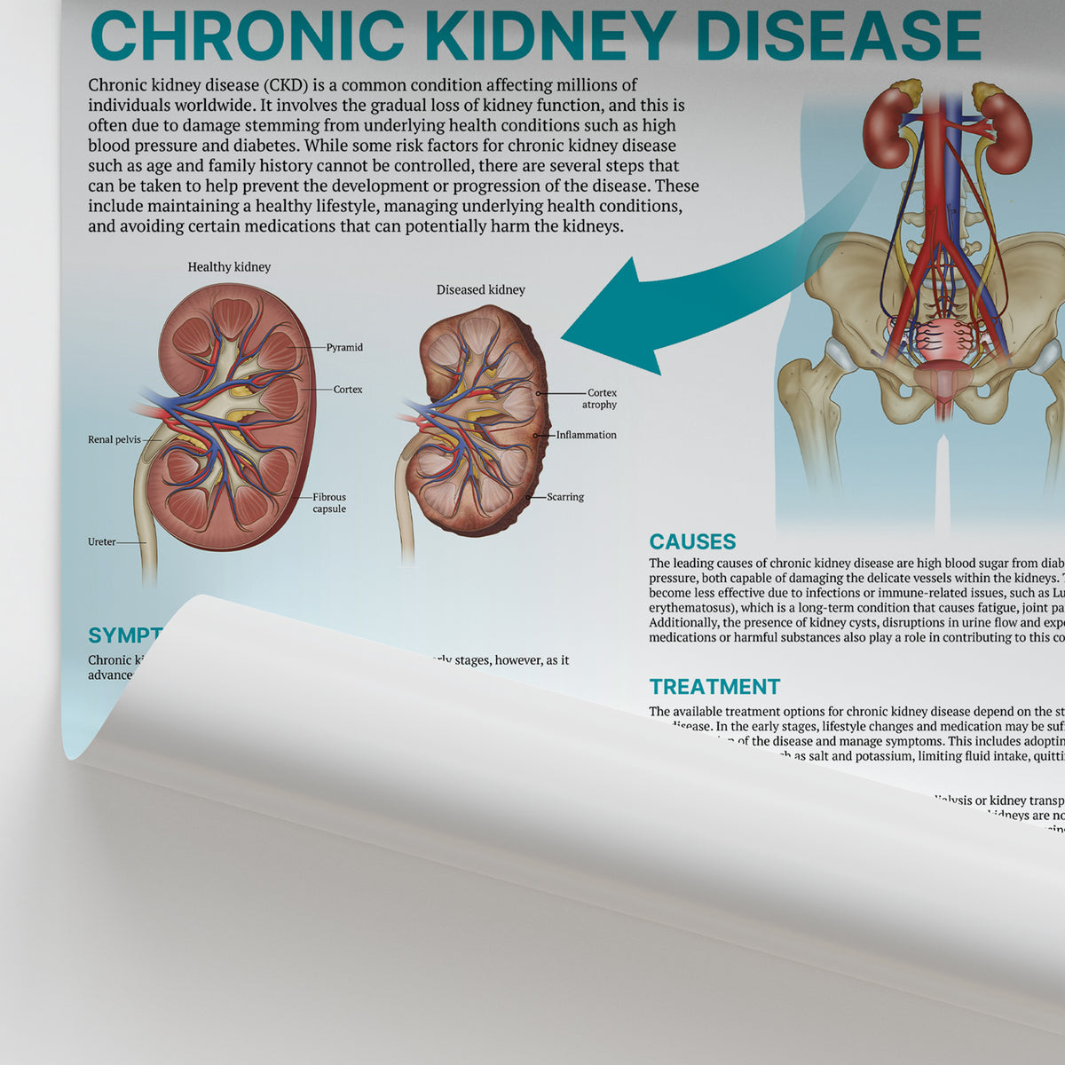 The Anatomy of Chronic Kidney Disease Chart/Poster Laminated – AnatomyStuff