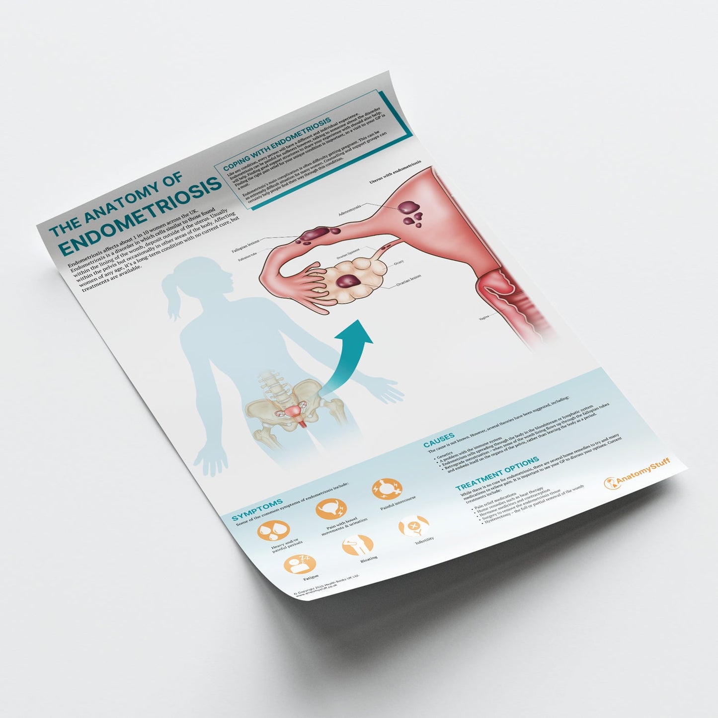 The Anatomy of Endometriosis Chart / Poster - Part of Collection