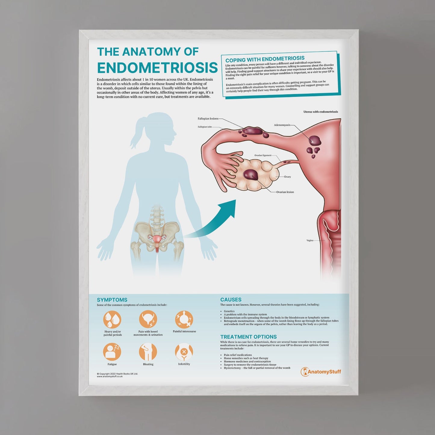 The Anatomy of Endometriosis Chart / Poster - Part of Collection