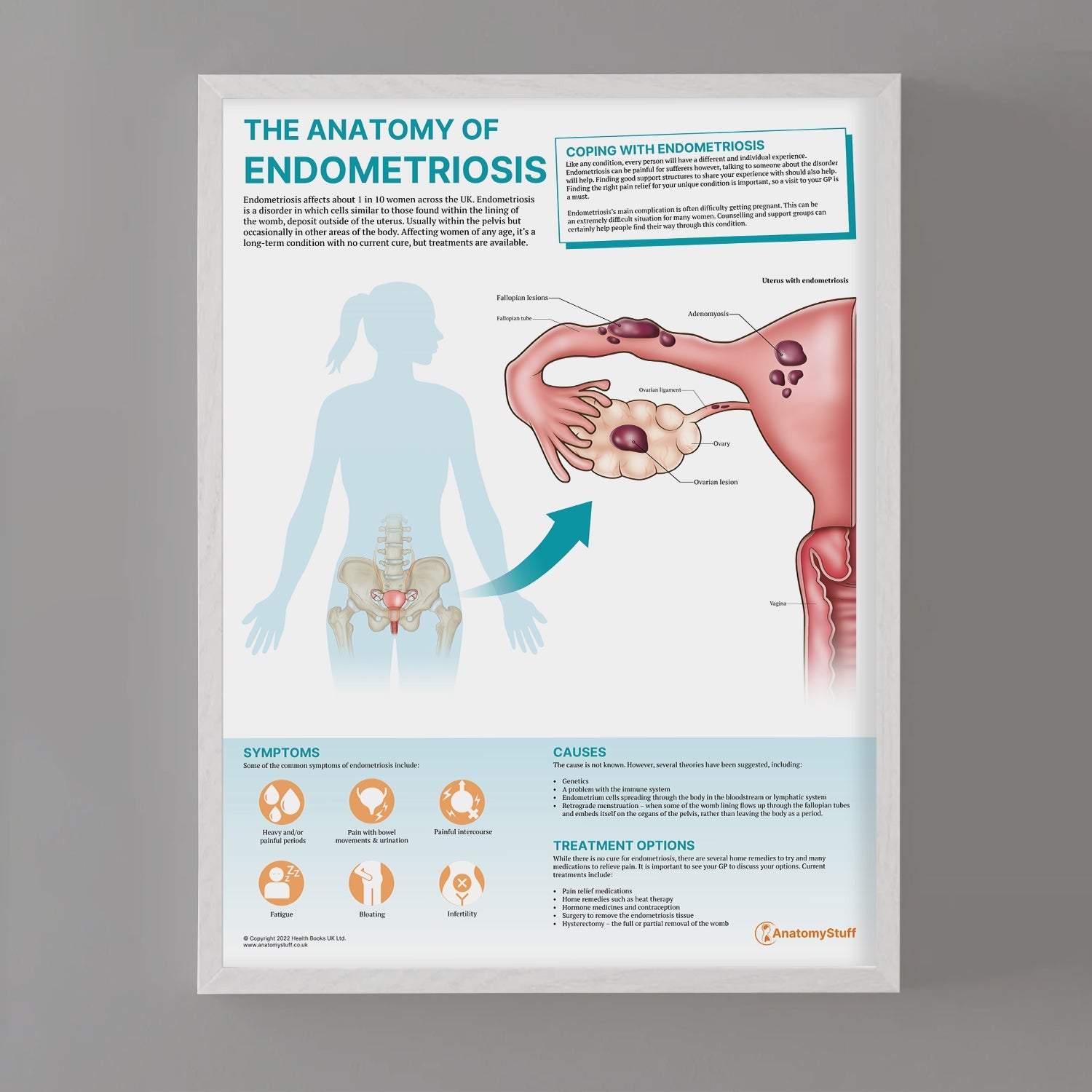 The Anatomy of Endometriosis Chart / Poster - Part of Collection