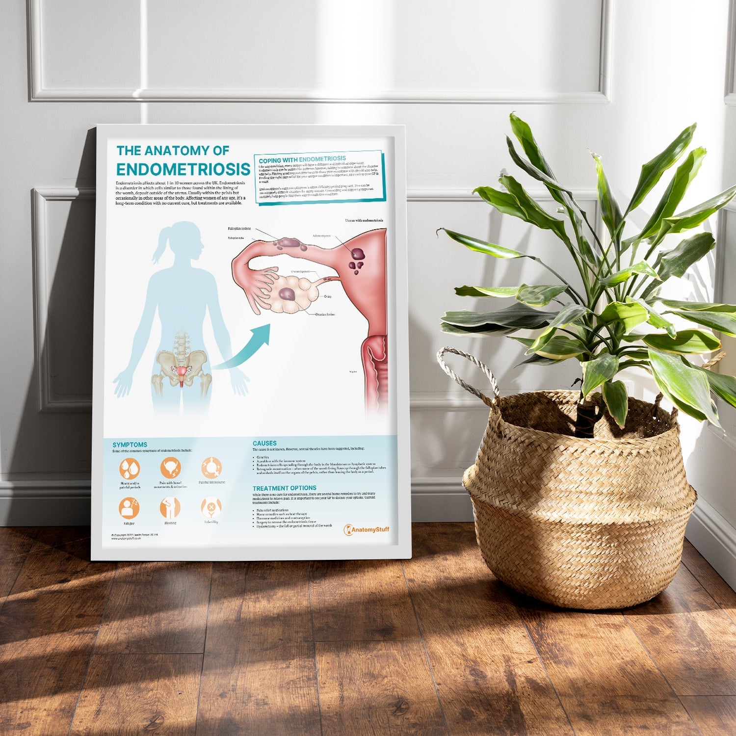 The Anatomy of Endometriosis Chart / Poster - Part of Collection