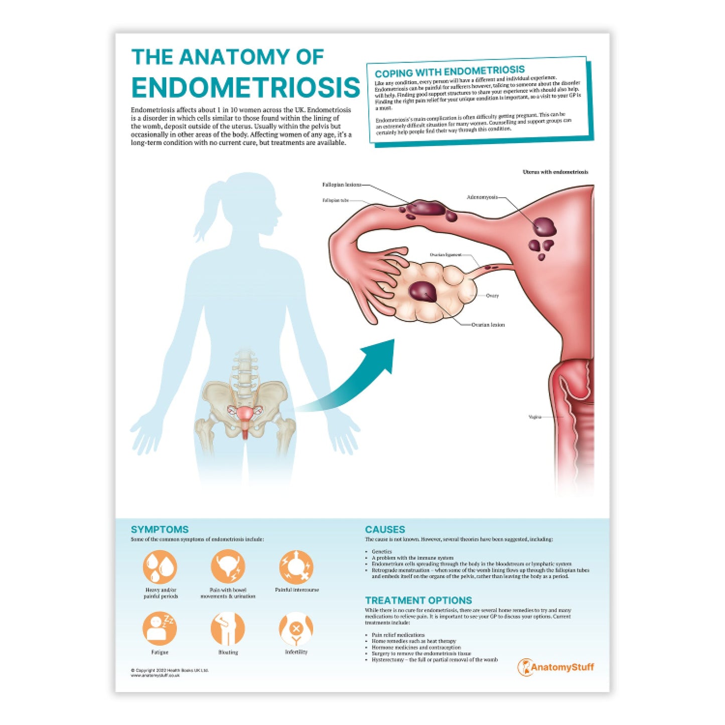 The Anatomy of Endometriosis Chart / Poster - Part of Collection