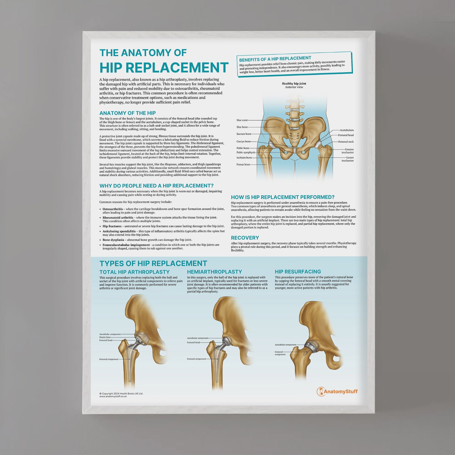 Hip Transposition The Anatomy of Hip Replacement | Knee Replacement Chart – AnatomyStuff