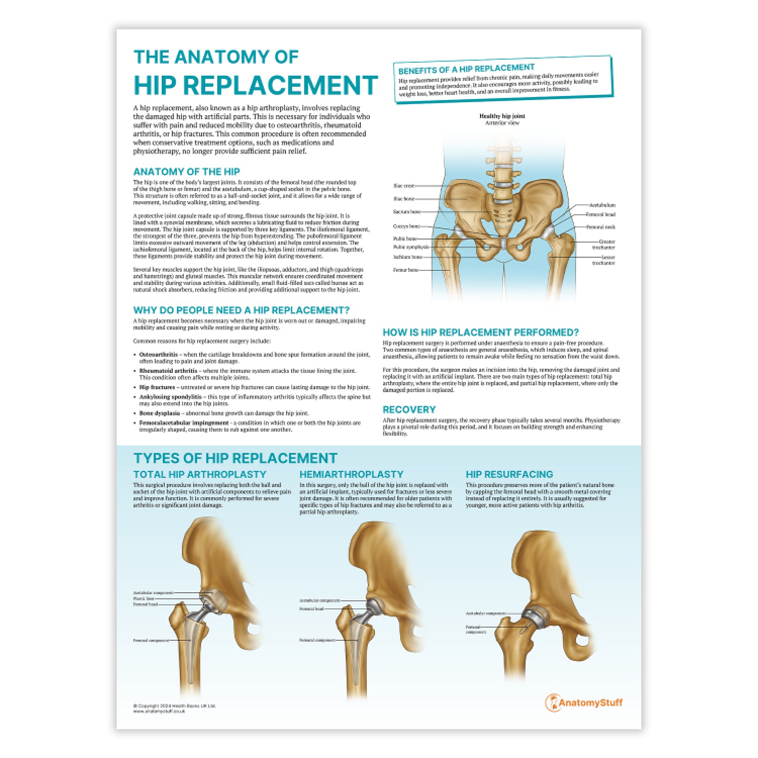 Hip Transposition The Anatomy of Hip Replacement | Knee Replacement Chart – AnatomyStuff