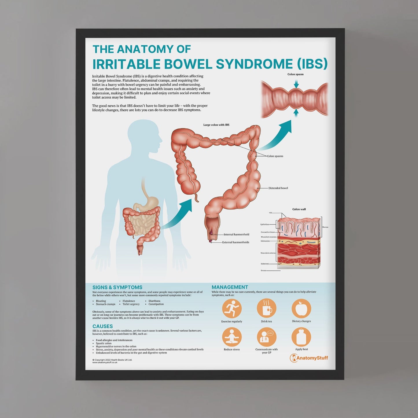 The Anatomy of Irritable Bowel Syndrome (IBS) Chart / Poster - Part of Collection