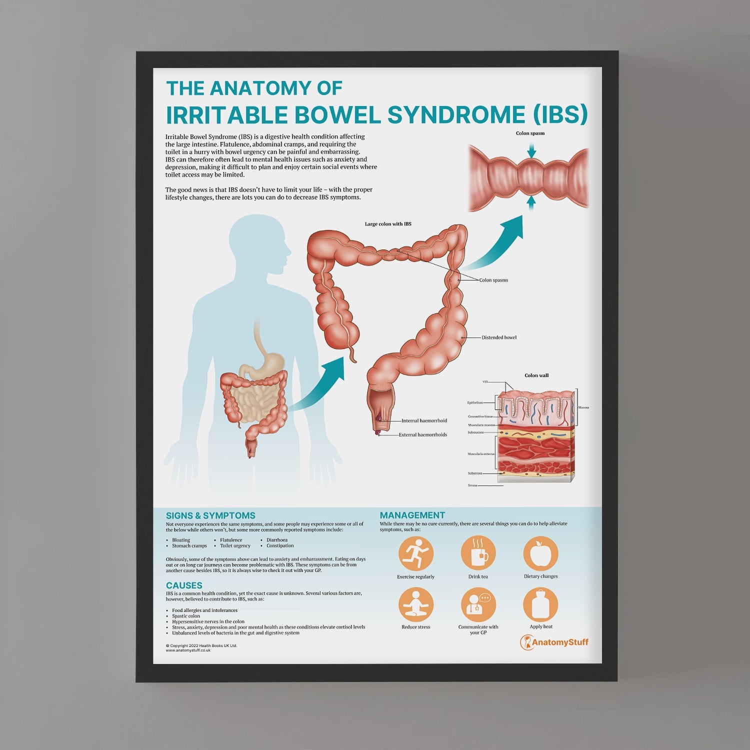 The Anatomy of Irritable Bowel Syndrome (IBS) Chart / Poster - Part of Collection