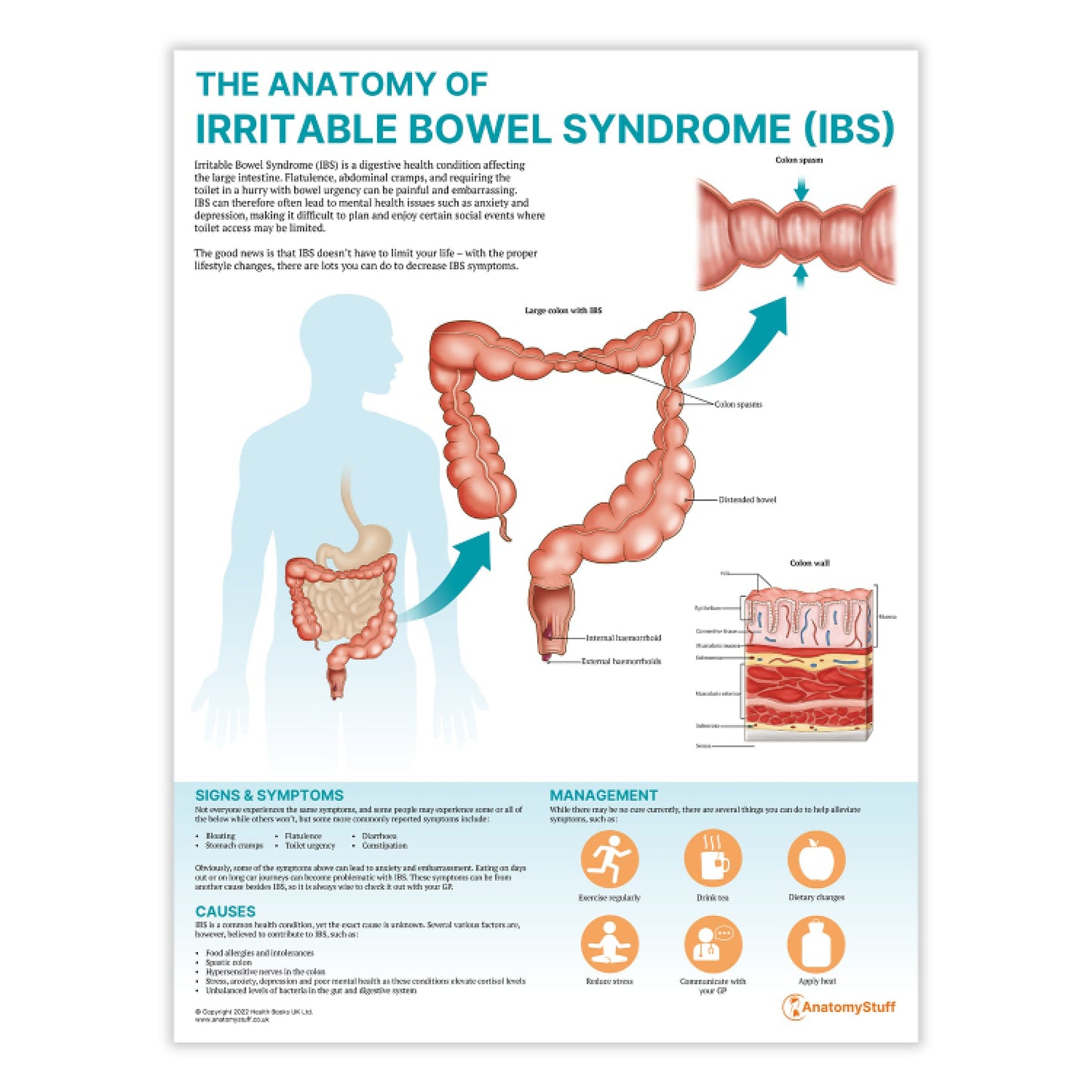 The Anatomy of Irritable Bowel Syndrome (IBS) Chart / Poster - Part of Collection
