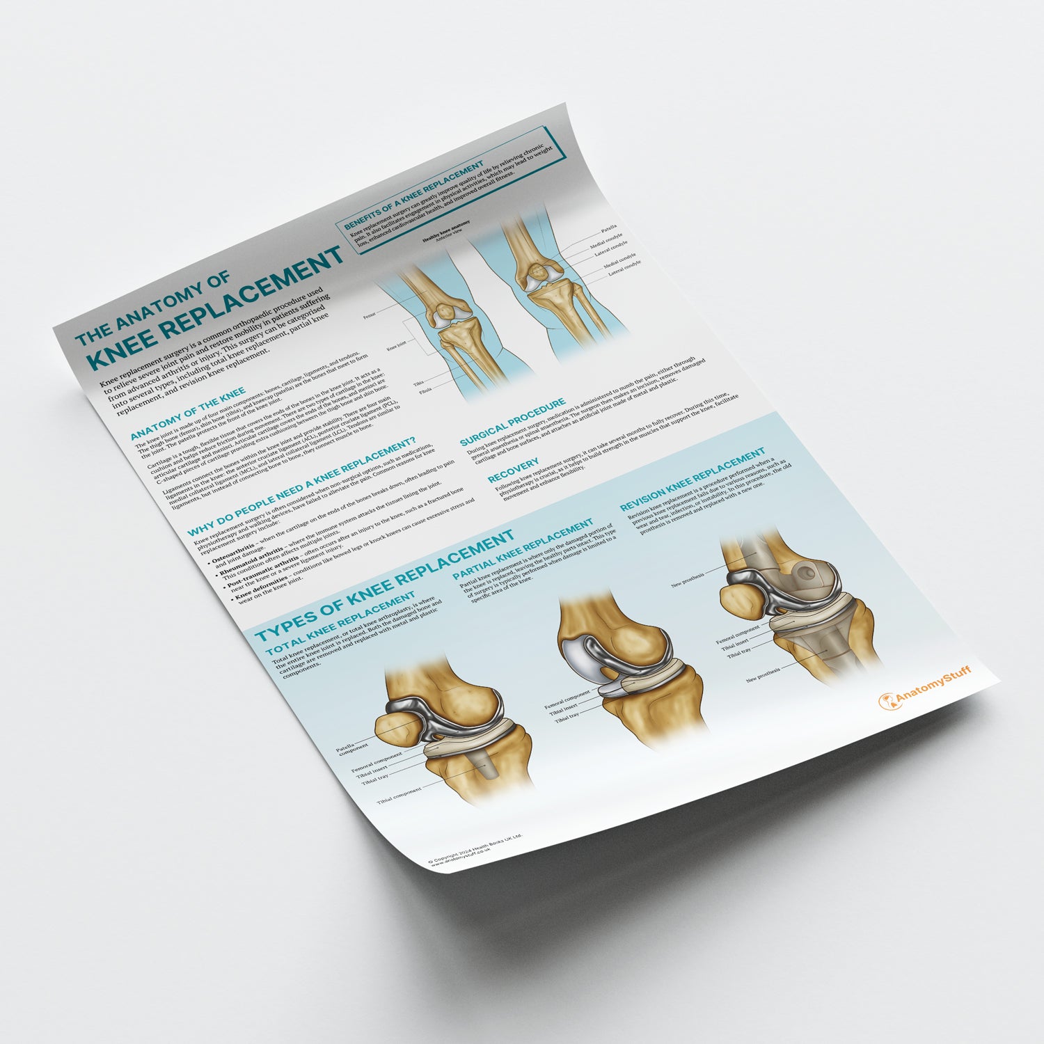 The Anatomy of Knee Replacement Chart / Poster