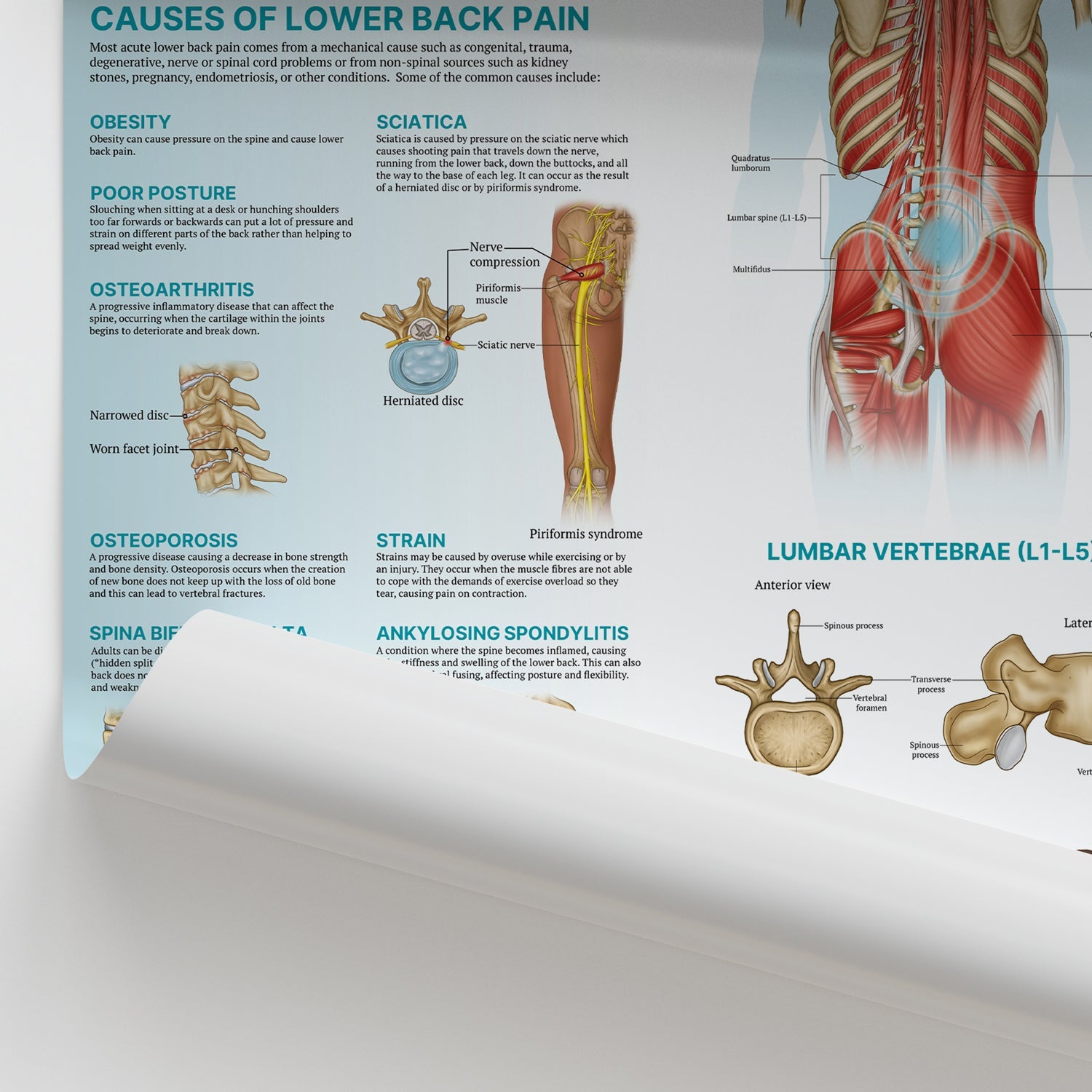 The Anatomy of Lower Back Pain Chart / Poster - Part of Collection