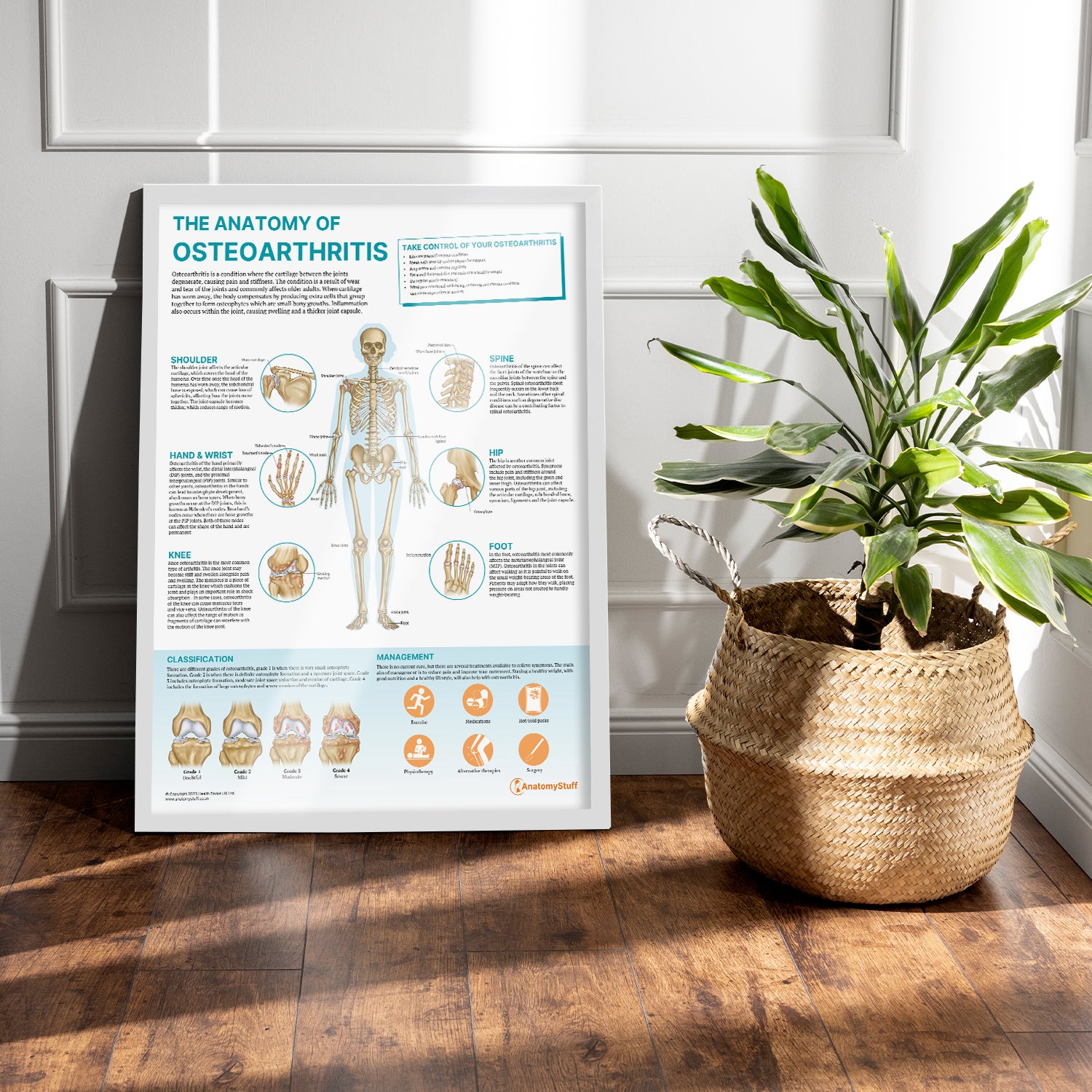 The Anatomy of Osteoarthritis Chart / Poster