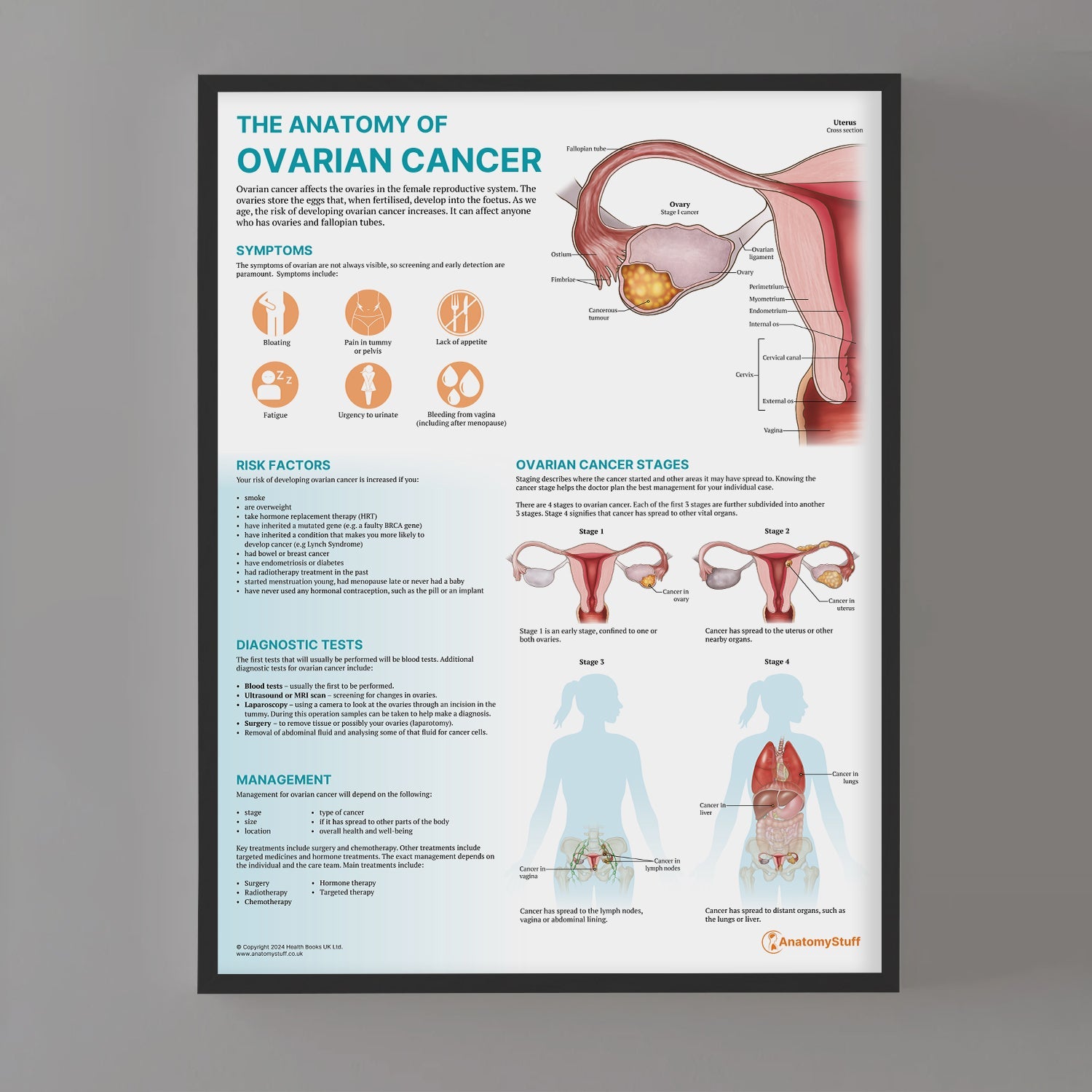 The Anatomy of Ovarian Cancer Chart / Poster - Part of Collection