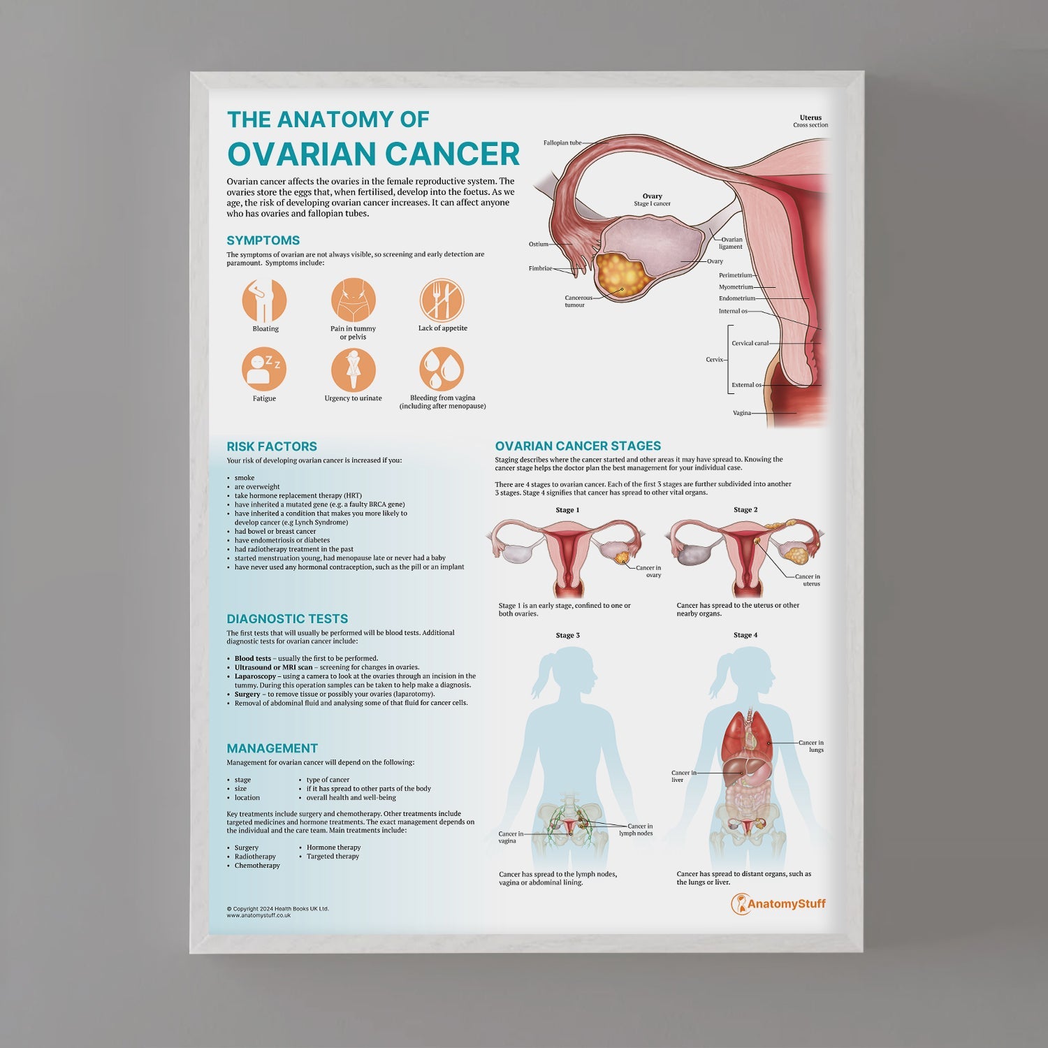 The Anatomy of Ovarian Cancer Chart / Poster - Part of Collection
