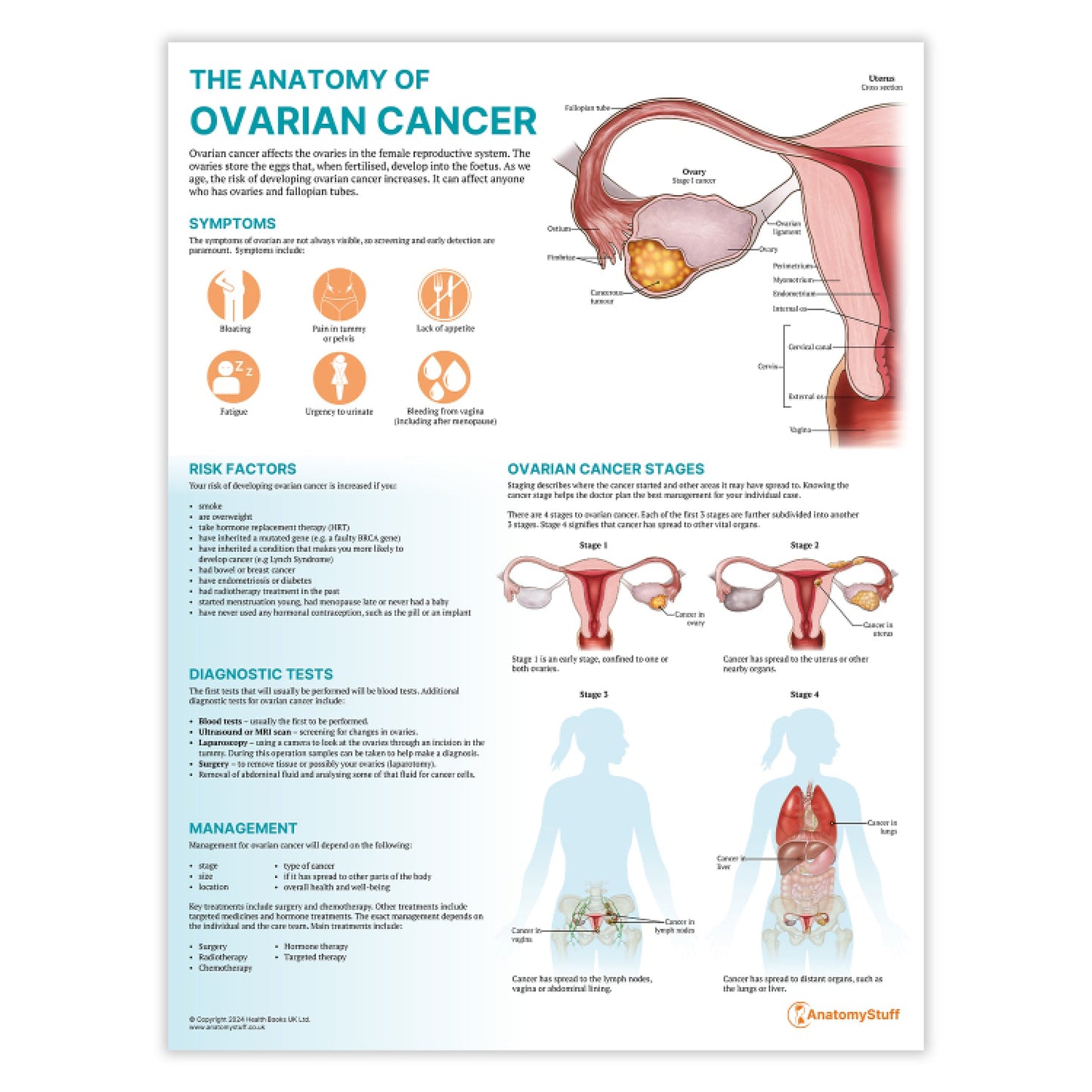 The Anatomy of Ovarian Cancer Chart / Poster - Part of Collection
