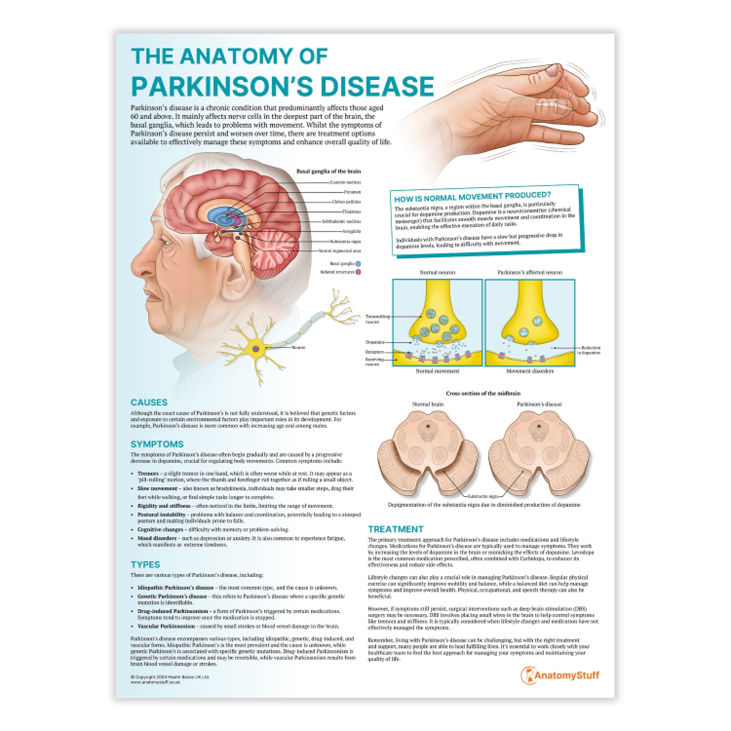 The Anatomy of Parkinson's Disease Chart/Poster | Neurological ...