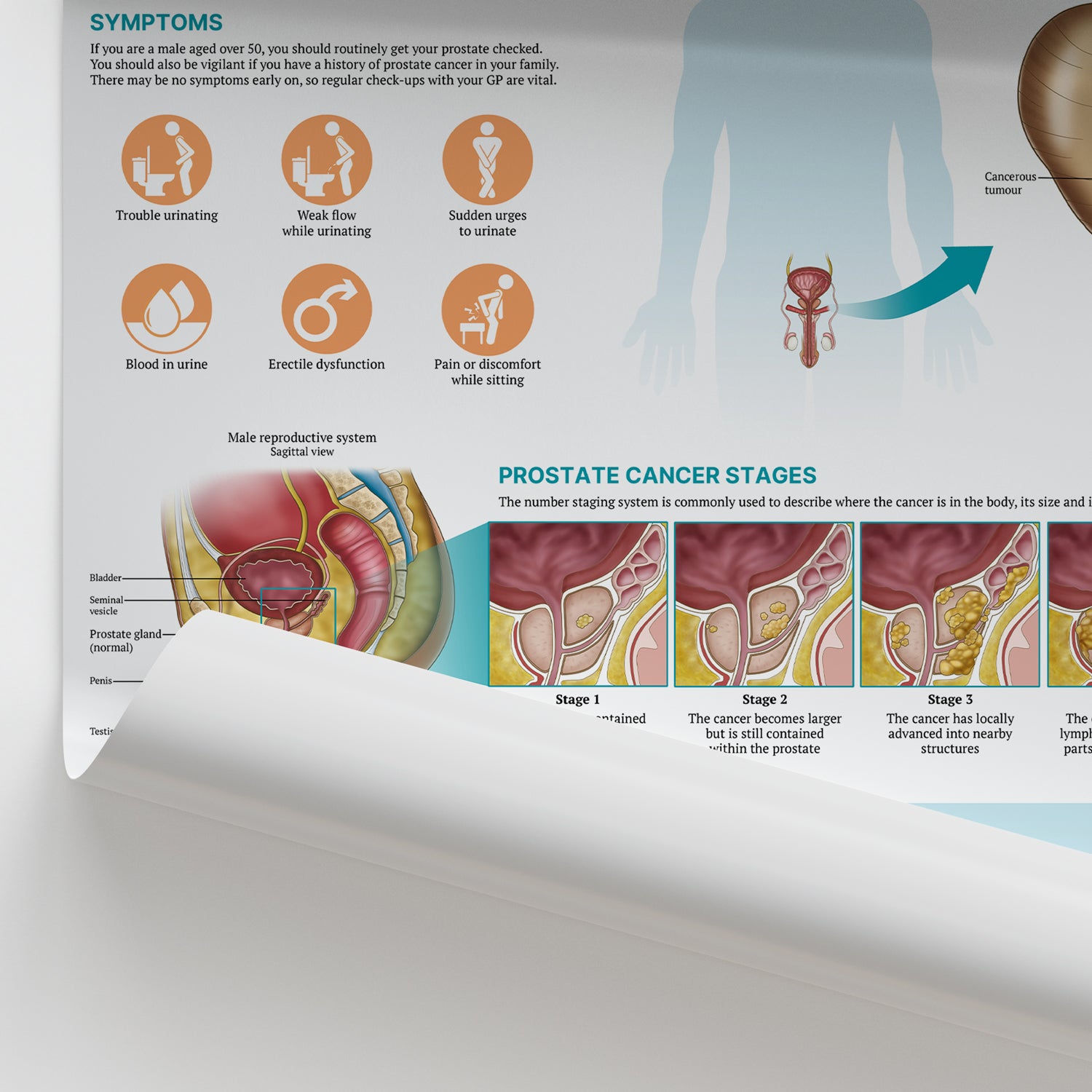 The Anatomy of Prostate Cancer Chart / Poster