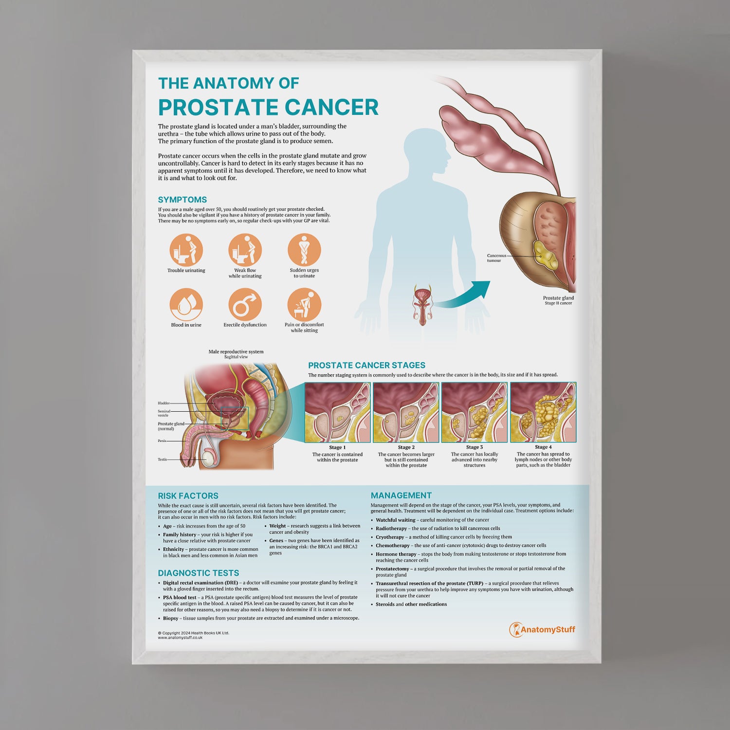 The Anatomy of Prostate Cancer Chart / Poster