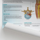 Switch The Anatomy of Sciatica Chart / Poster 2 image