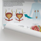 Switch The Anatomy of Stress Incontinence Chart / Poster 2 image