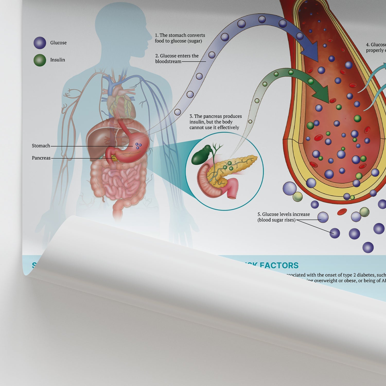 The Anatomy of Type 2 Diabetes Chart / Poster - Part of Collection