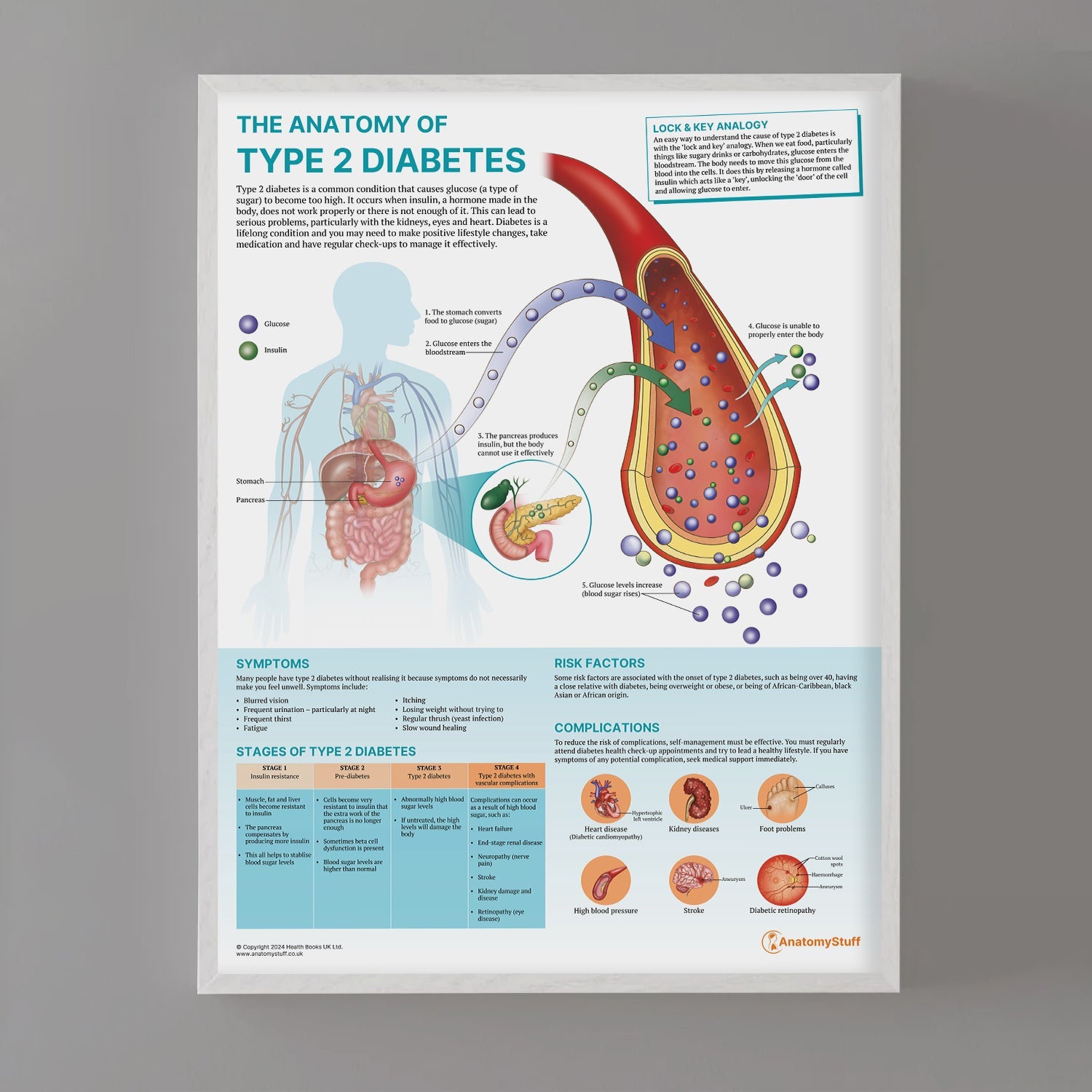 The Anatomy of Type 2 Diabetes Chart / Poster - Part of Collection