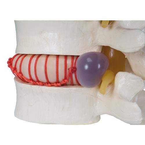 Prolapsed Disc Spinal Simulator